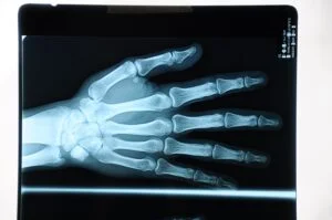 xray of hand