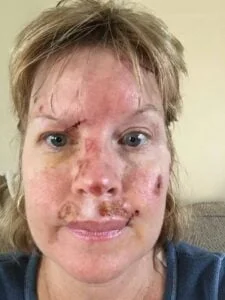 Judy's face ravaged by skin cancer
